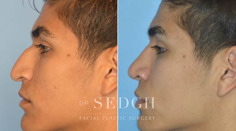 Male Rhinoplasty Before and After | Sedgh