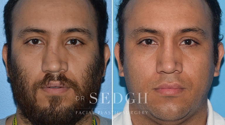 Male Rhinoplasty Before and After | Sedgh