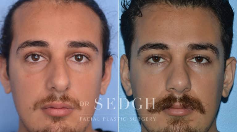 Male Rhinoplasty Before and After | Sedgh