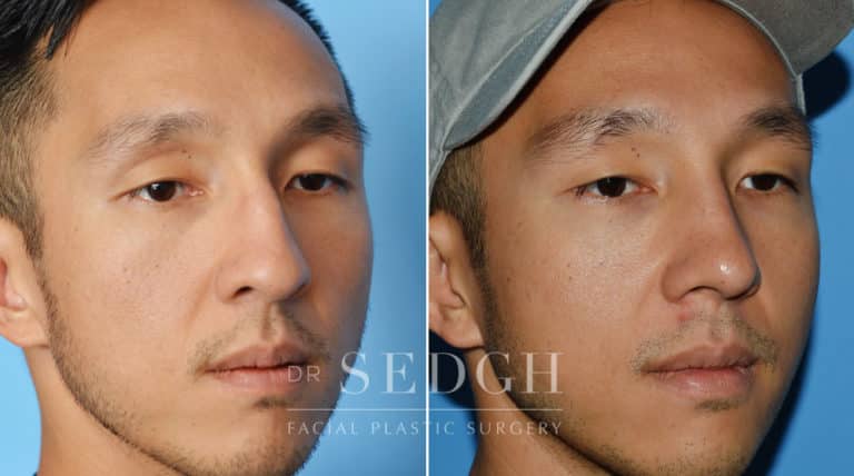 Male Rhinoplasty Before and After | Sedgh