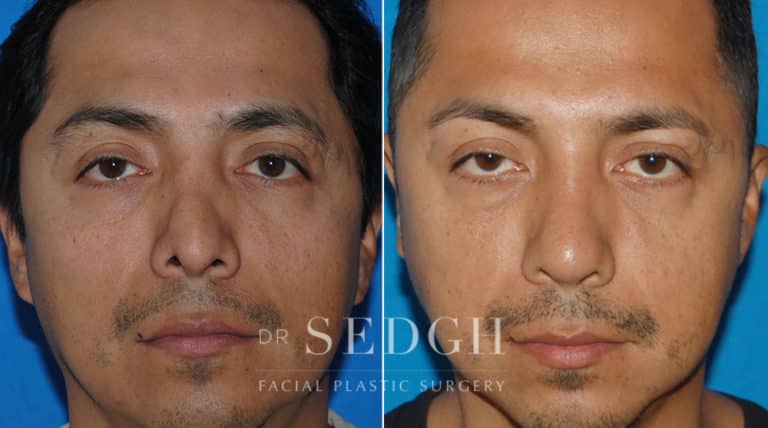 Male Rhinoplasty Before and After | Sedgh