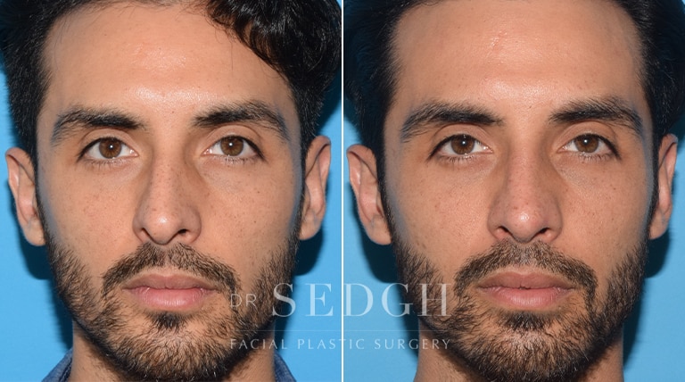 Male Rhinoplasty Before and After | Sedgh