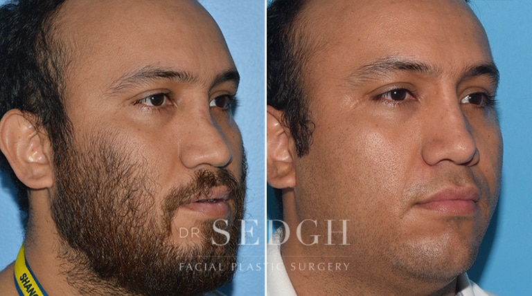 Male Rhinoplasty Before and After | Sedgh