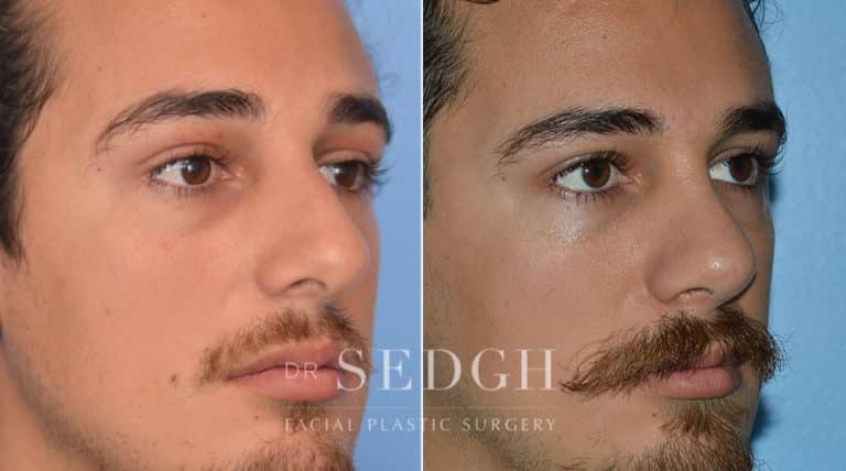 Male Rhinoplasty Before and After | Sedgh