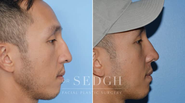 Male Rhinoplasty Before and After | Sedgh