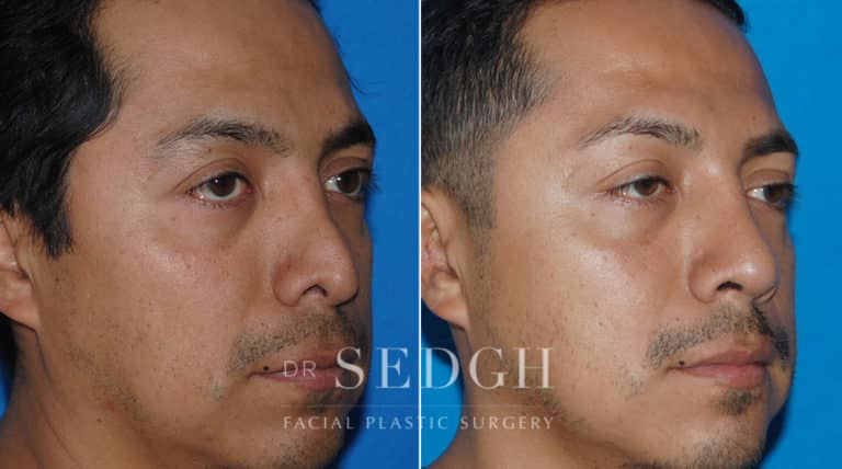 Male Rhinoplasty Before and After | Sedgh