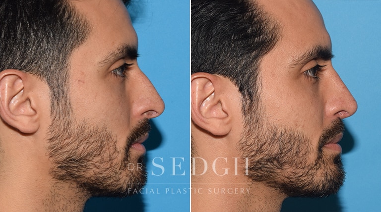 Male Rhinoplasty Before and After | Sedgh