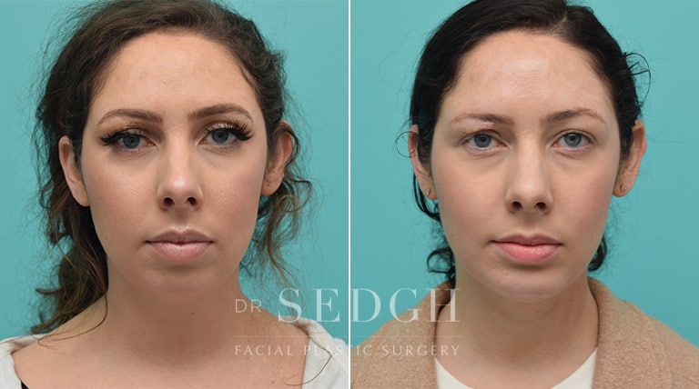 Chin Augmentation Before and after photos, Sandy Springs, GA