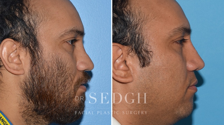 Male Rhinoplasty Before and After | Sedgh