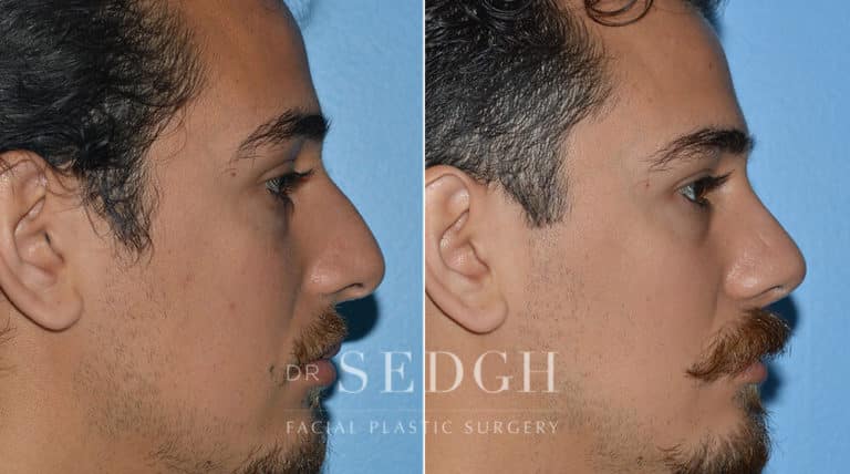 Male Rhinoplasty Before and After | Sedgh