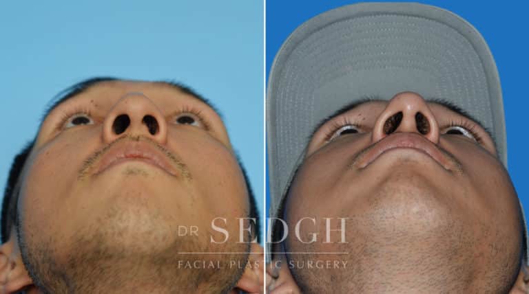 Male Rhinoplasty Before and After | Sedgh