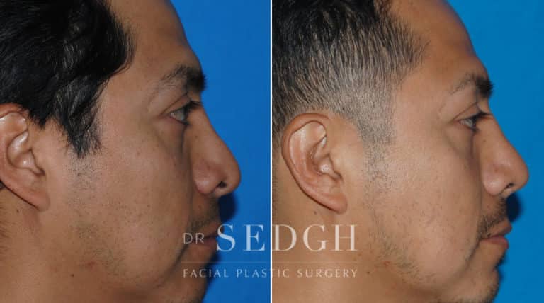 Male Rhinoplasty Before and After | Sedgh