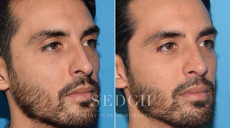 Male Rhinoplasty Before and After | Sedgh