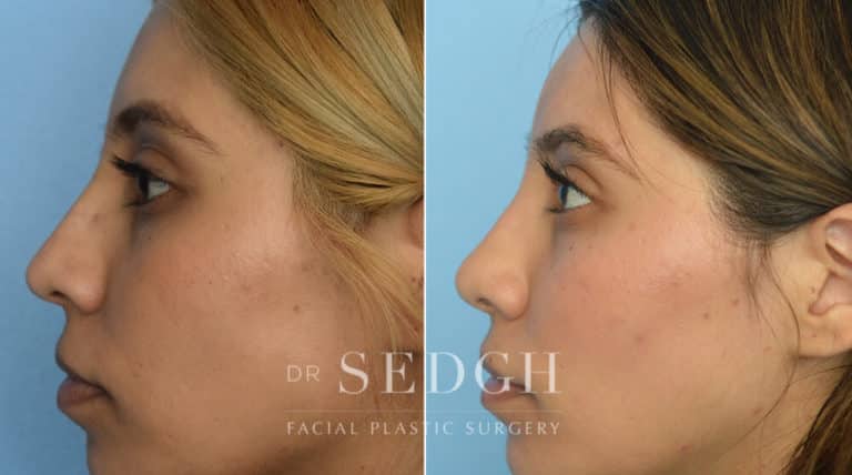 Latino Rhinoplasty Before and After | Sedgh