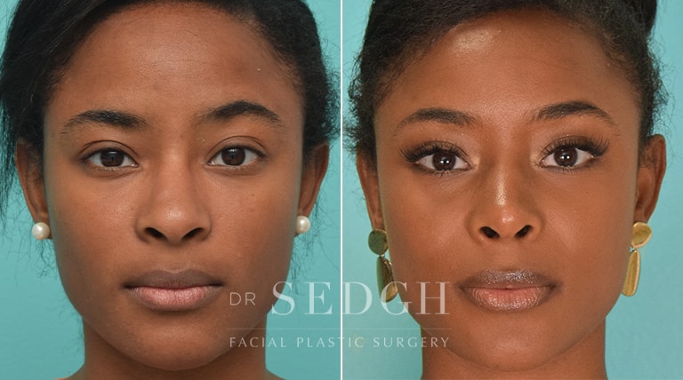 African American Rhinoplasty Before & After | Dr. Sedgh