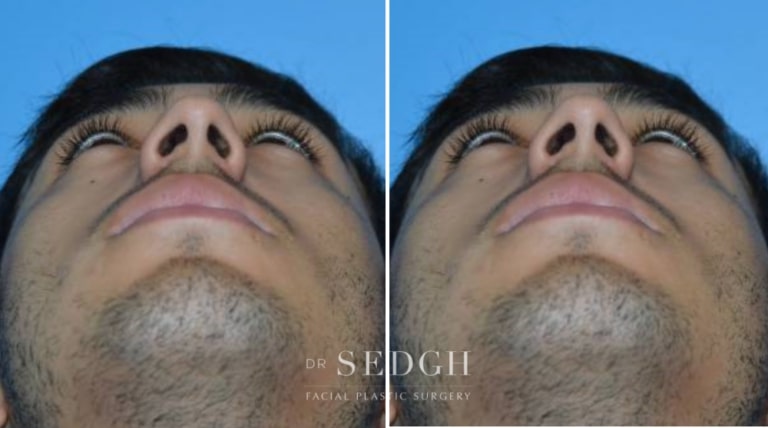 Male Rhinoplasty Before and After | Sedgh