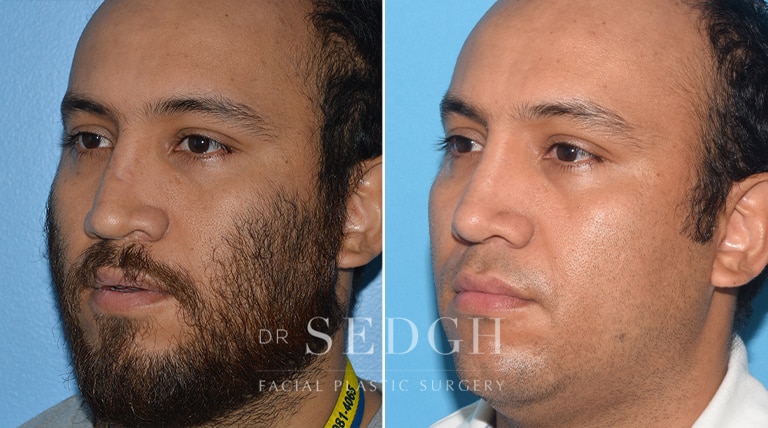 rhinoplasty before and after male india