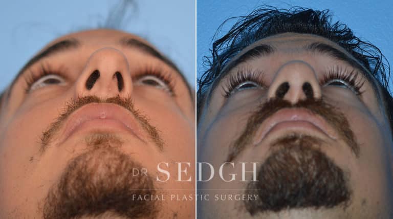 Male Rhinoplasty Before and After | Sedgh