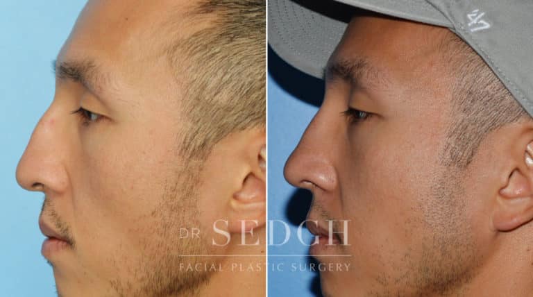 Male Rhinoplasty Before and After | Sedgh