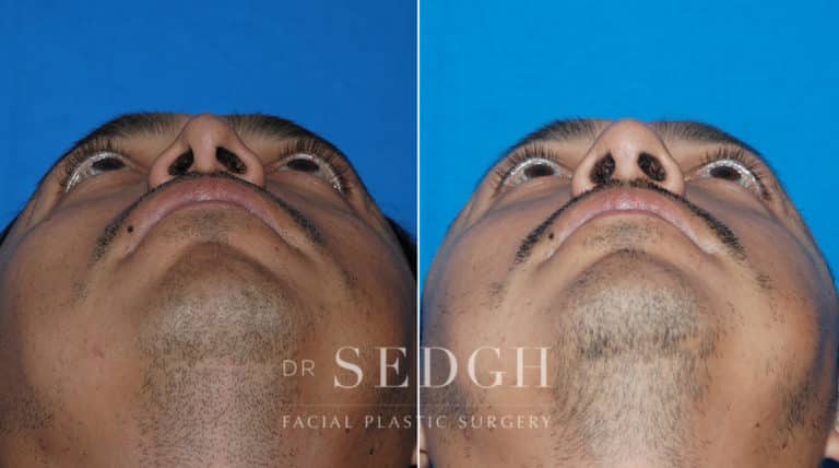 Male Rhinoplasty Before and After | Sedgh