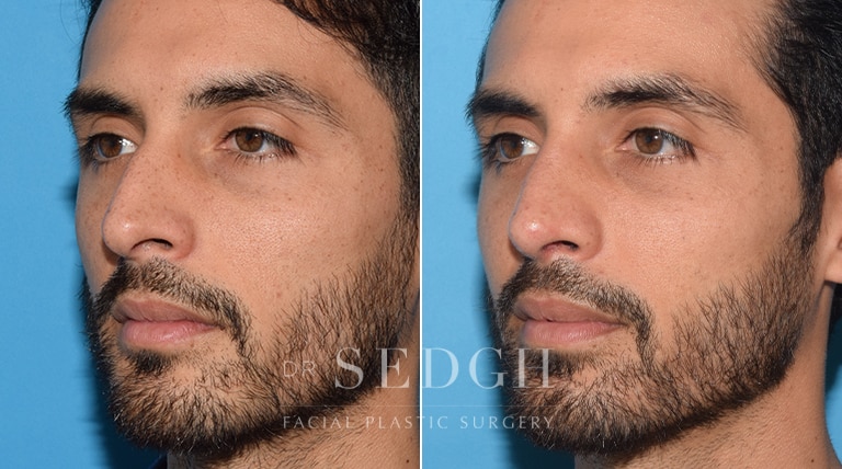 Male Rhinoplasty Before and After | Sedgh