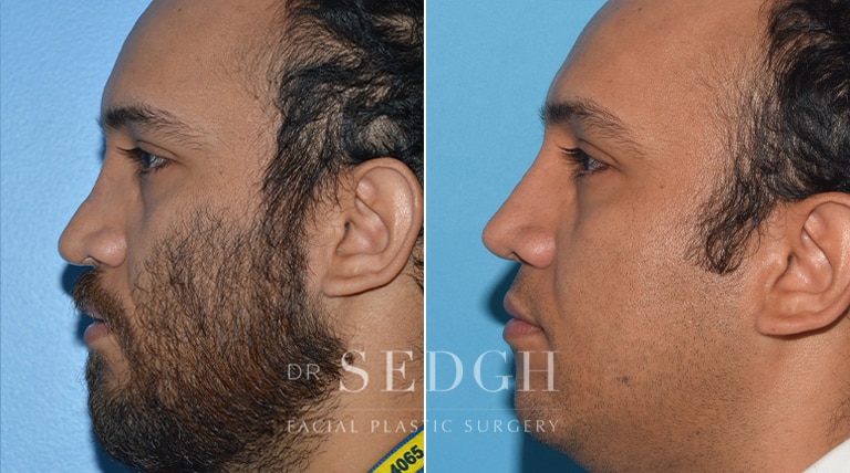 Male Rhinoplasty Before and After | Sedgh