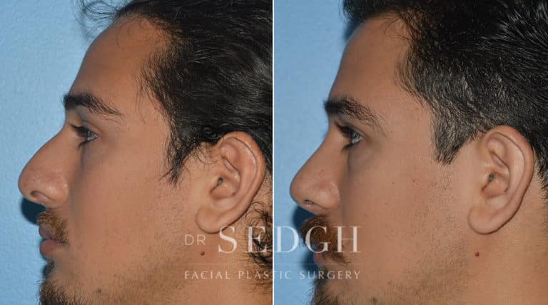 Male Rhinoplasty Before and After | Sedgh