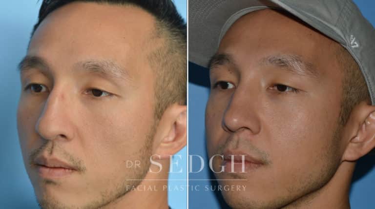 Male Rhinoplasty Before and After | Sedgh