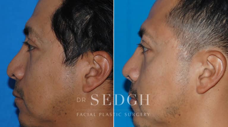 Male Rhinoplasty Before and After | Sedgh