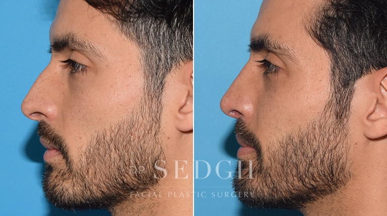 Male Rhinoplasty Before and After | Sedgh