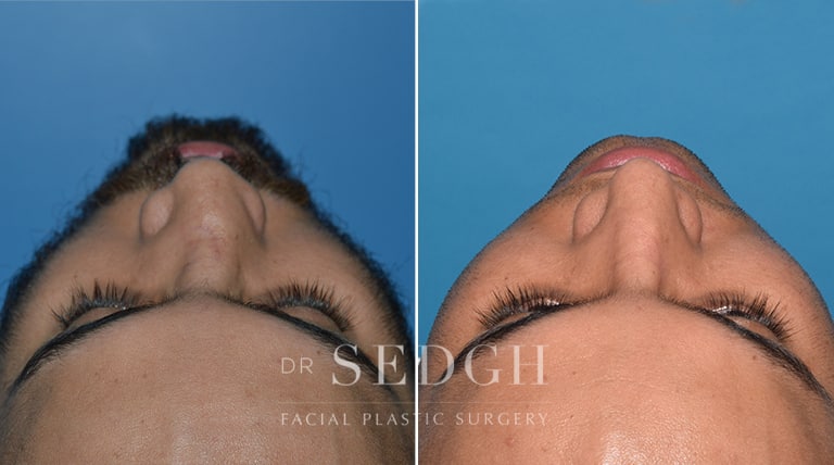 Male Rhinoplasty Before and After | Sedgh