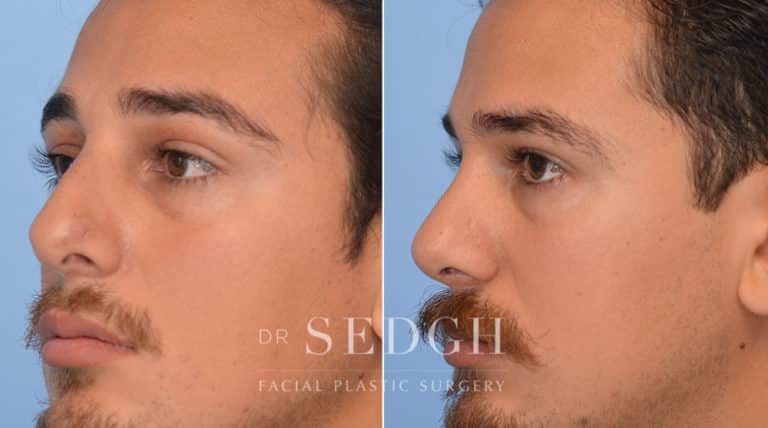 Male Rhinoplasty Before and After | Sedgh