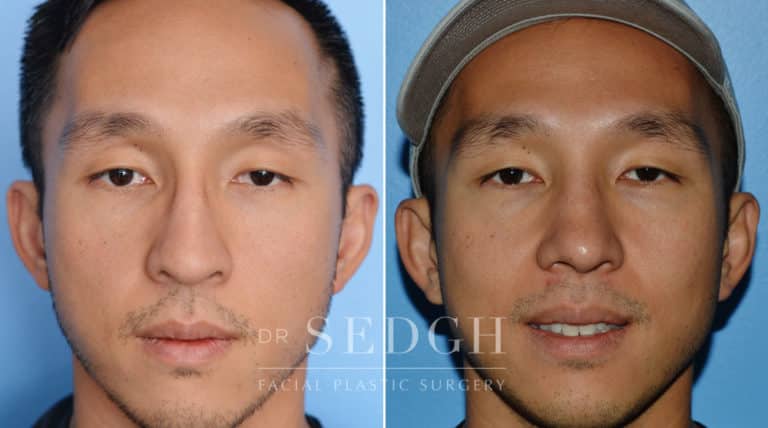 Male Rhinoplasty Before and After | Sedgh