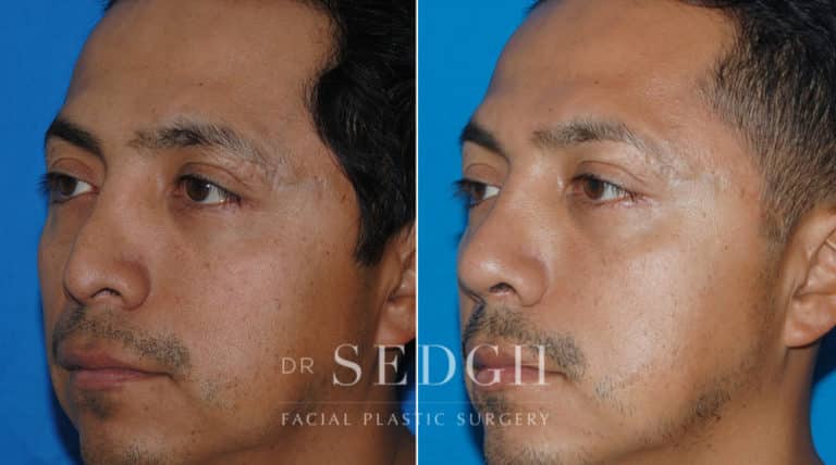 Male Rhinoplasty Before and After | Sedgh