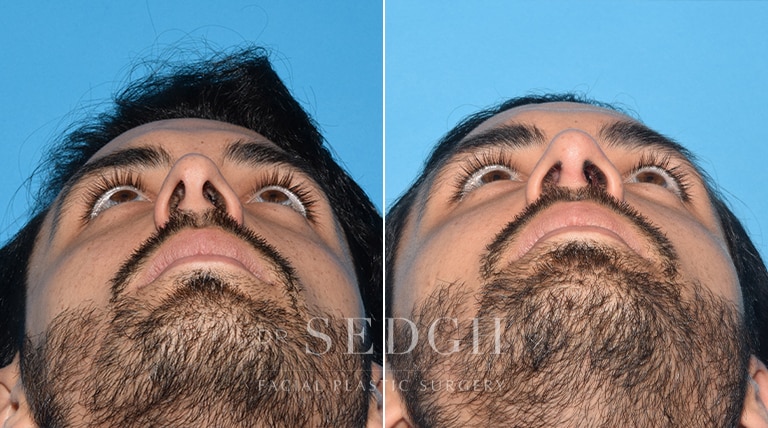 Male Rhinoplasty Before and After | Sedgh