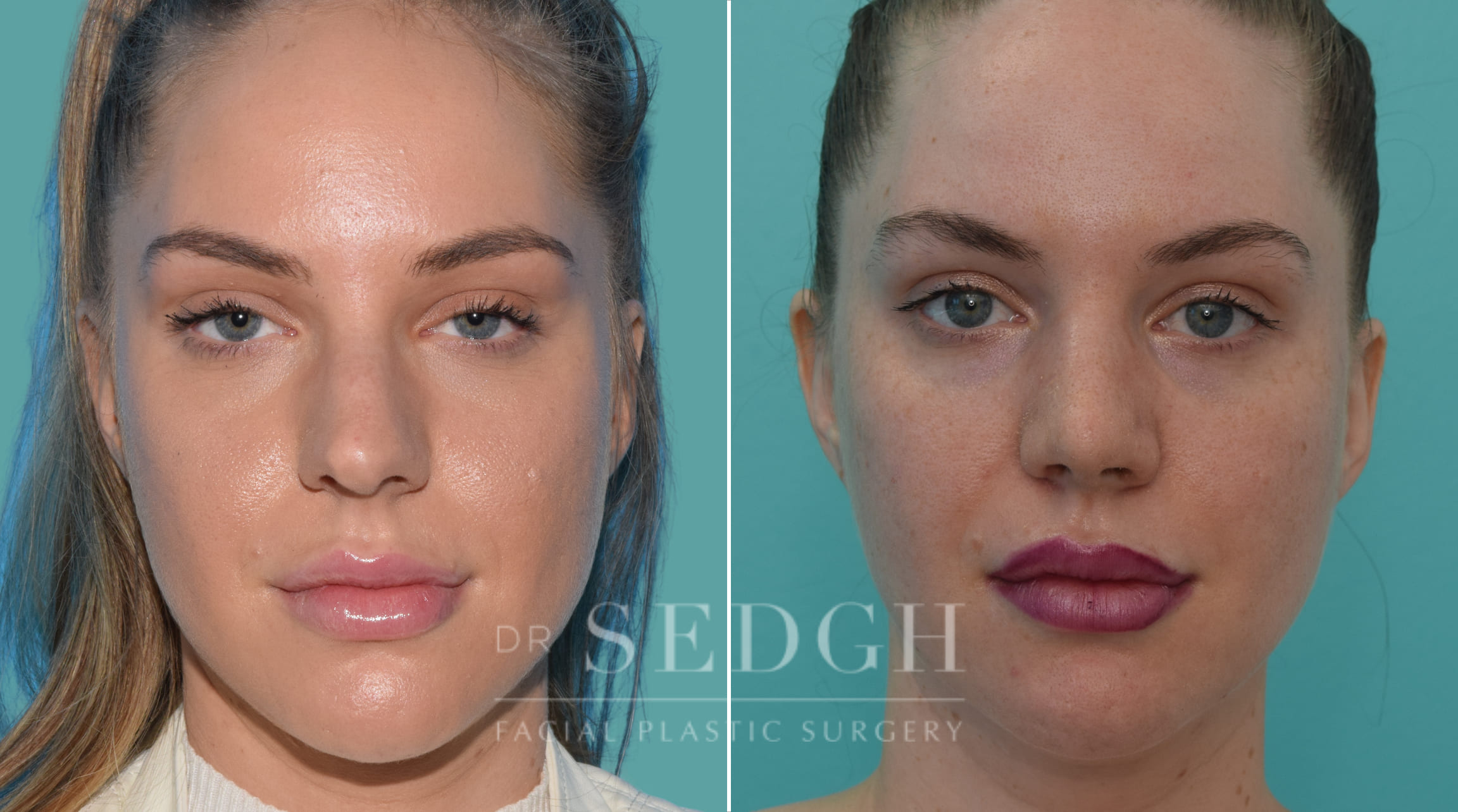 female patient before and after rhinoplasty procedure | Sedgh