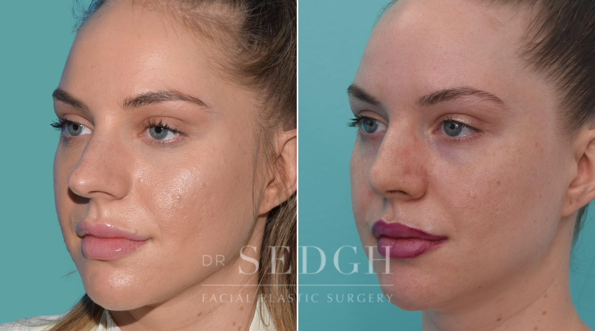 female patient before and after rhinoplasty procedure | Sedgh