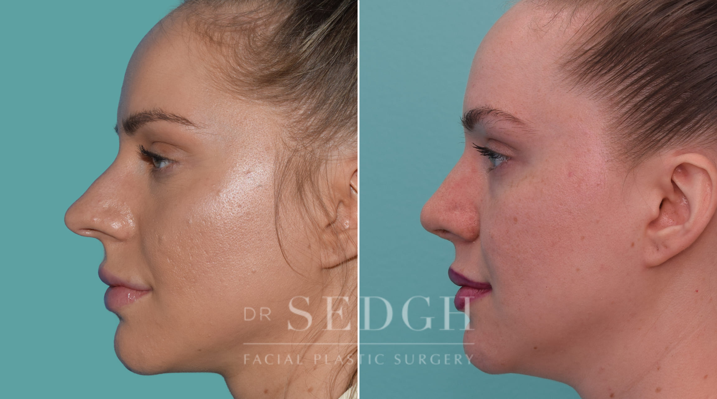 female patient before and after rhinoplasty procedure | Sedgh