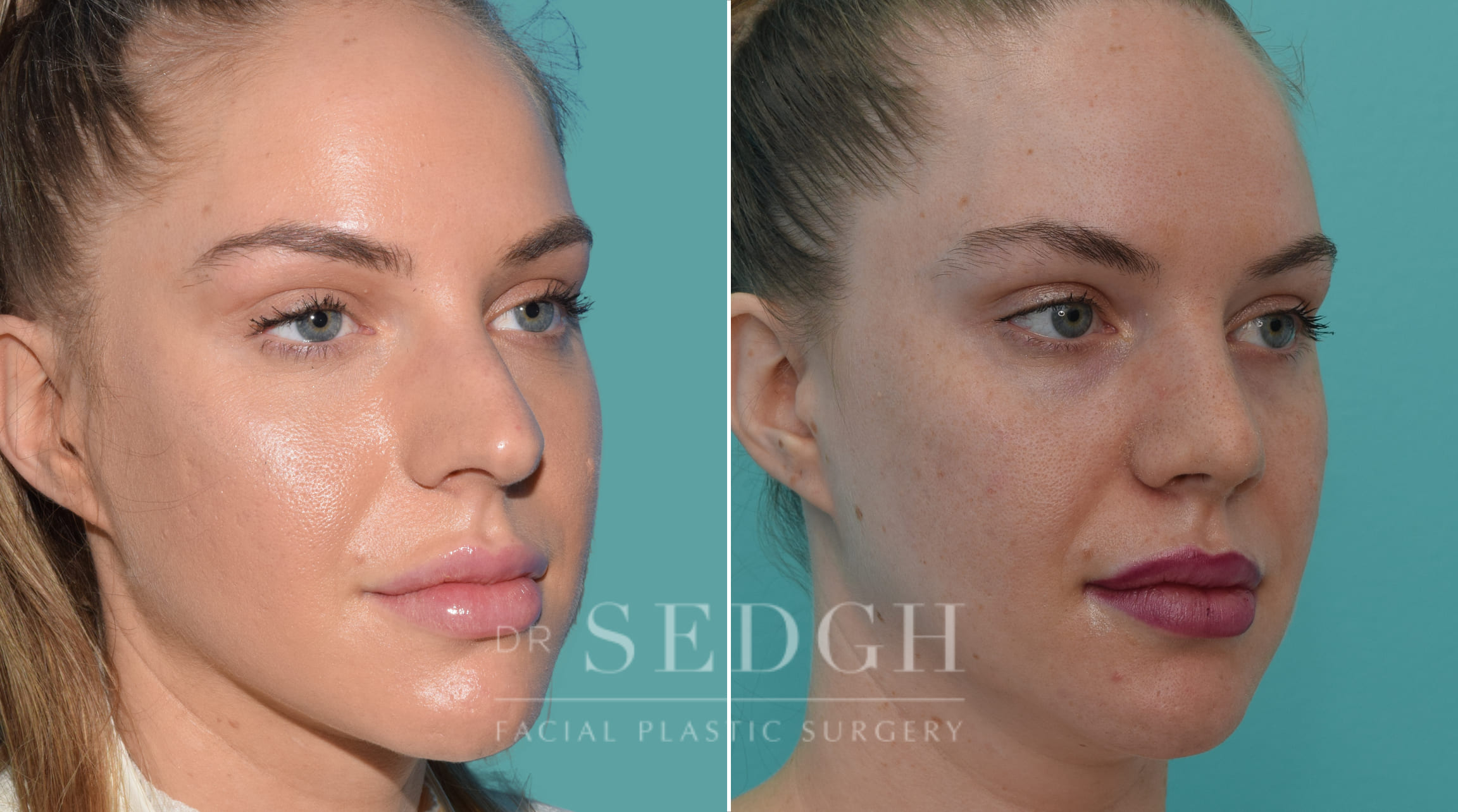 female patient before and after rhinoplasty procedure | Sedgh