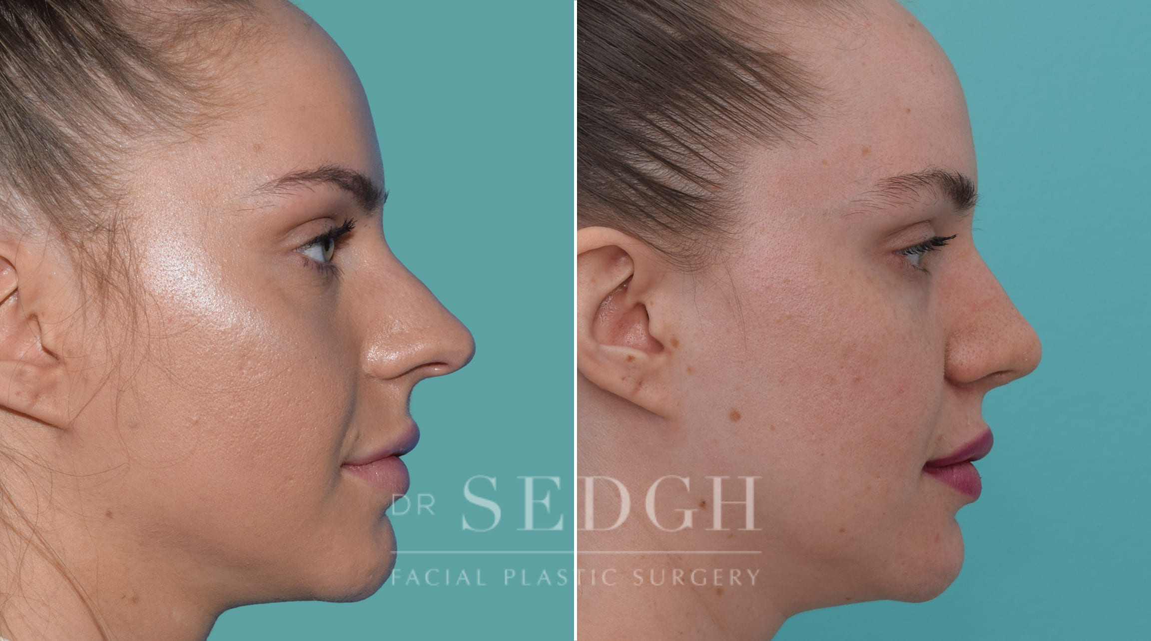 female patient before and after rhinoplasty procedure | Sedgh