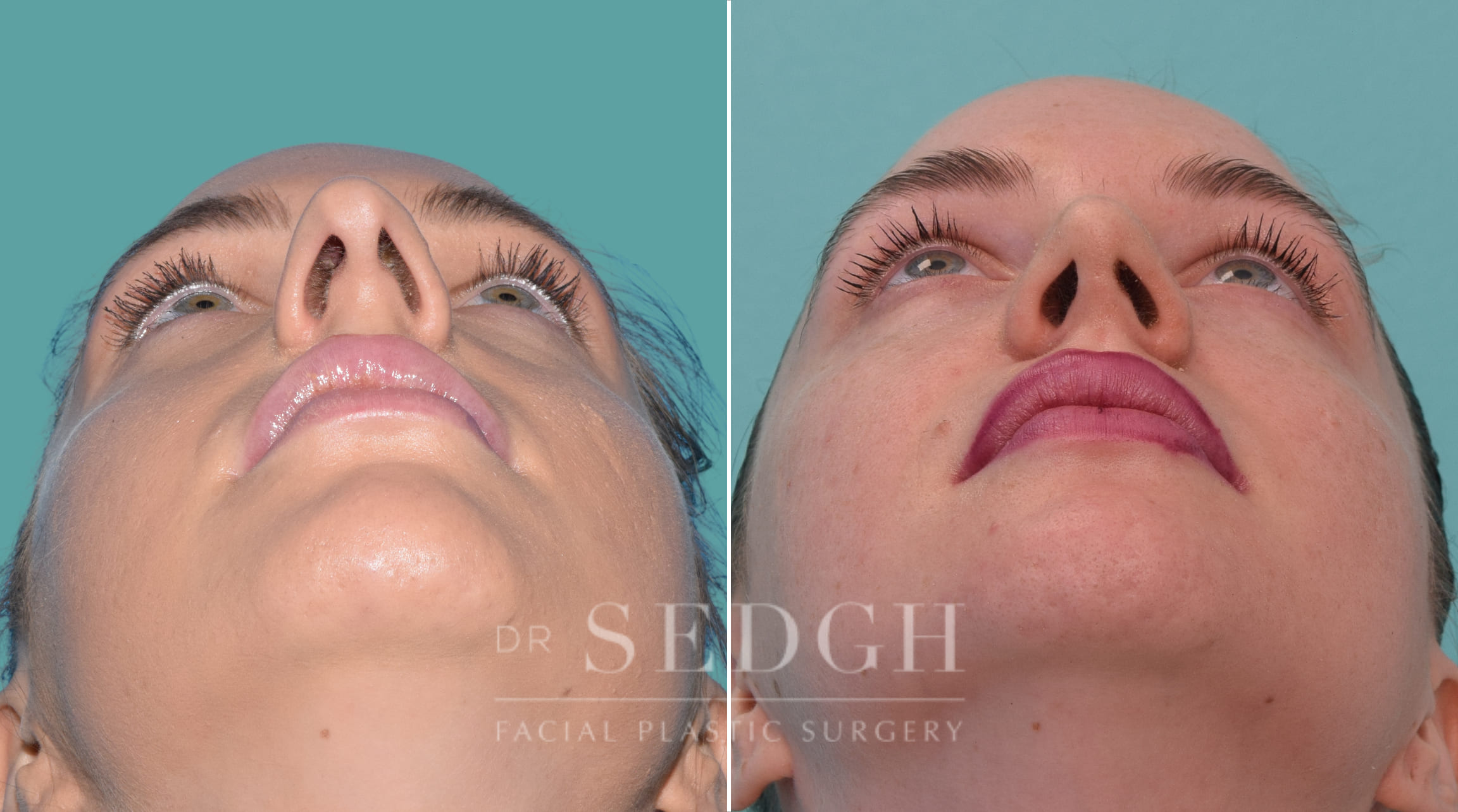 female patient before and after rhinoplasty procedure | Sedgh