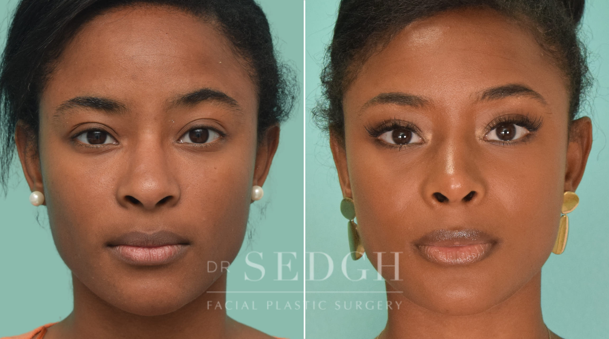 female patient before and after rhinoplasty procedure