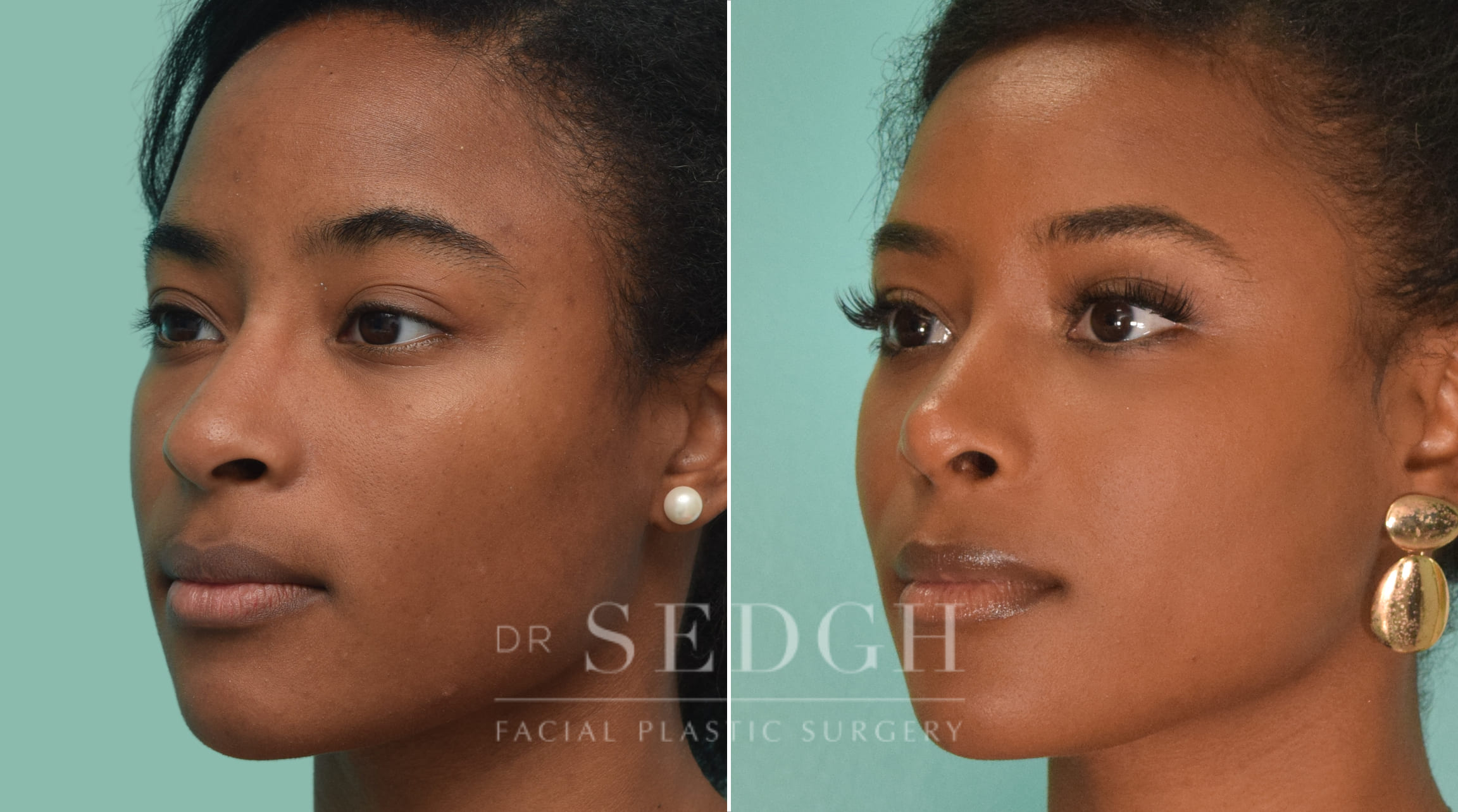 female patient before and after rhinoplasty procedure