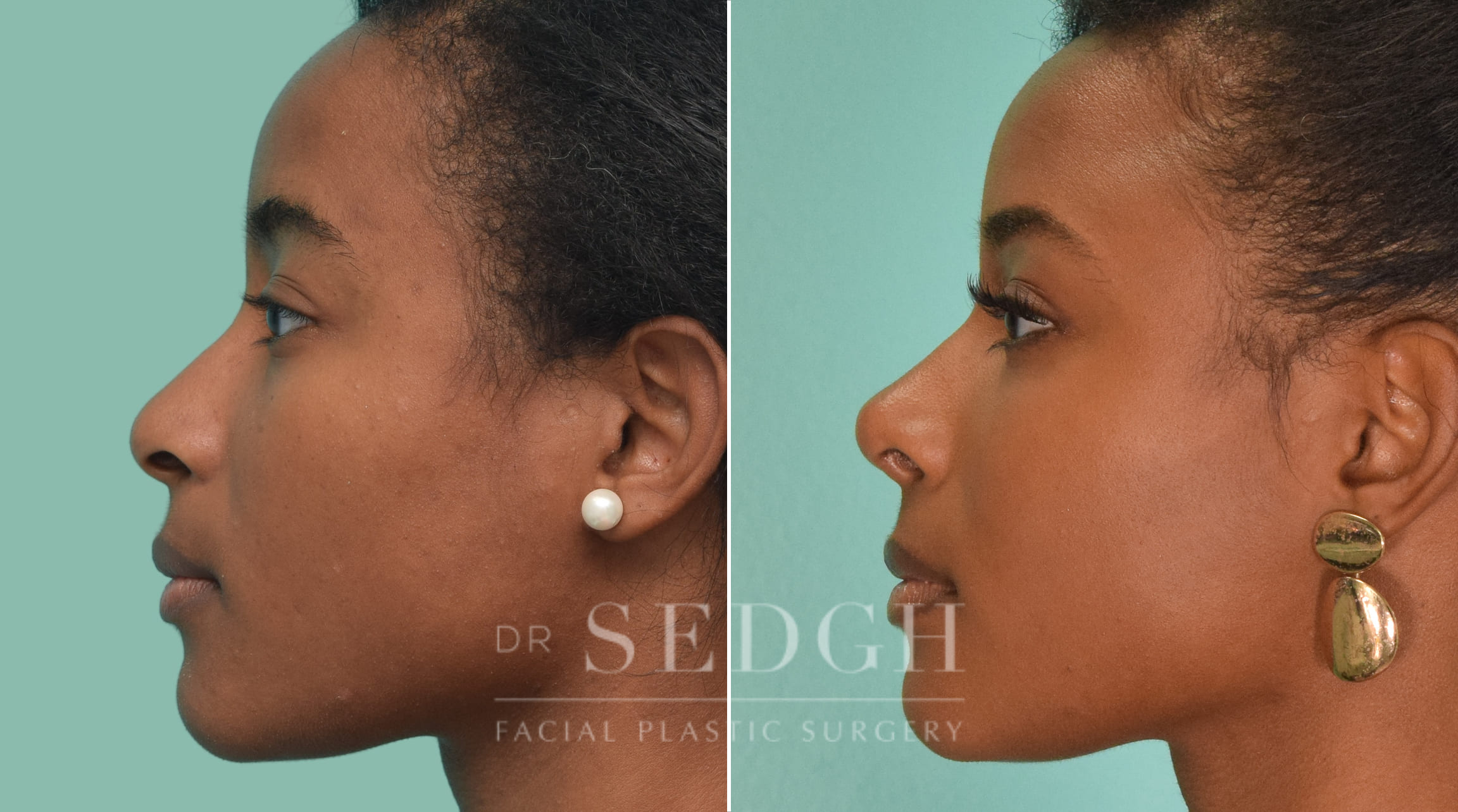 female patient before and after rhinoplasty procedure