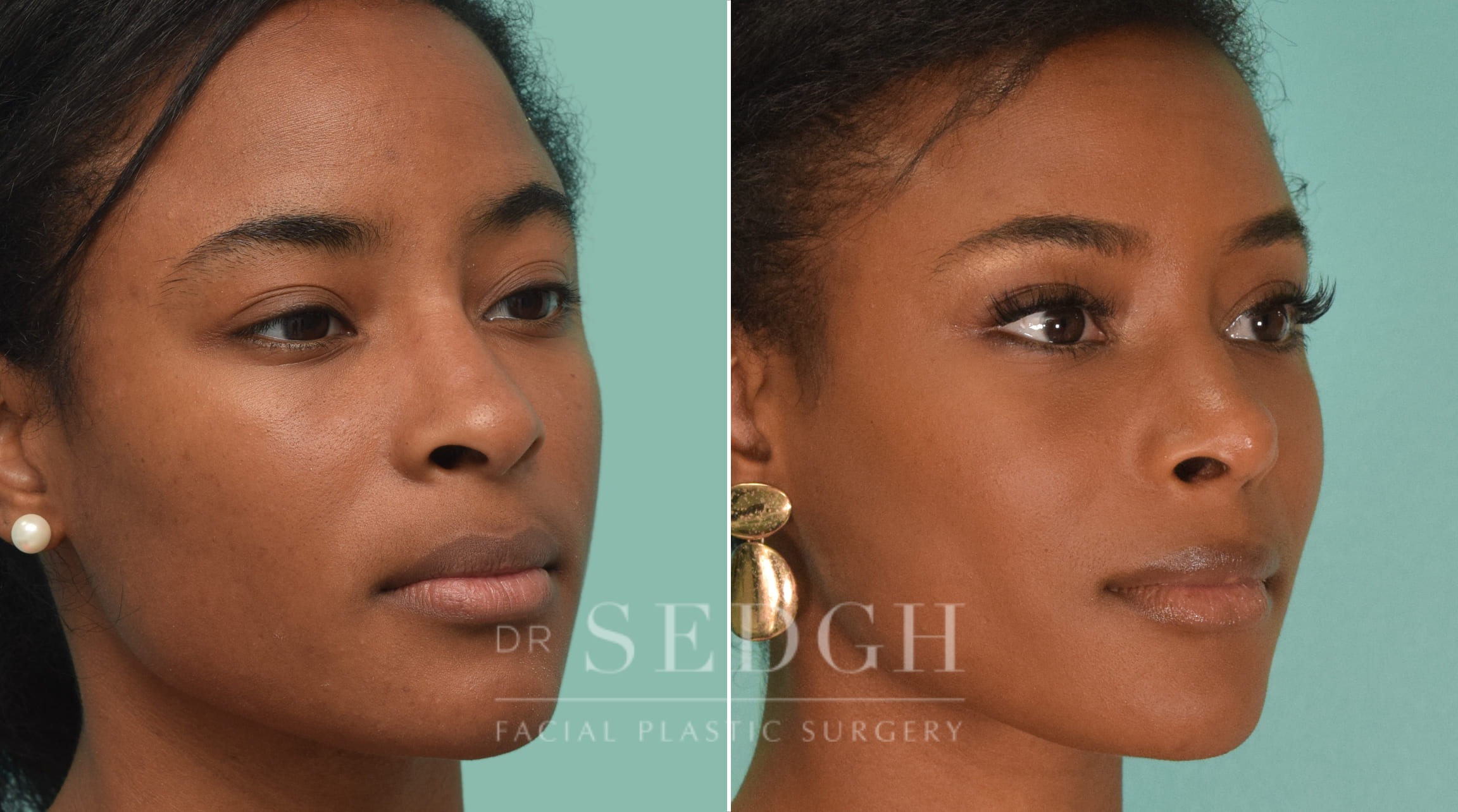 female patient before and after rhinoplasty procedure