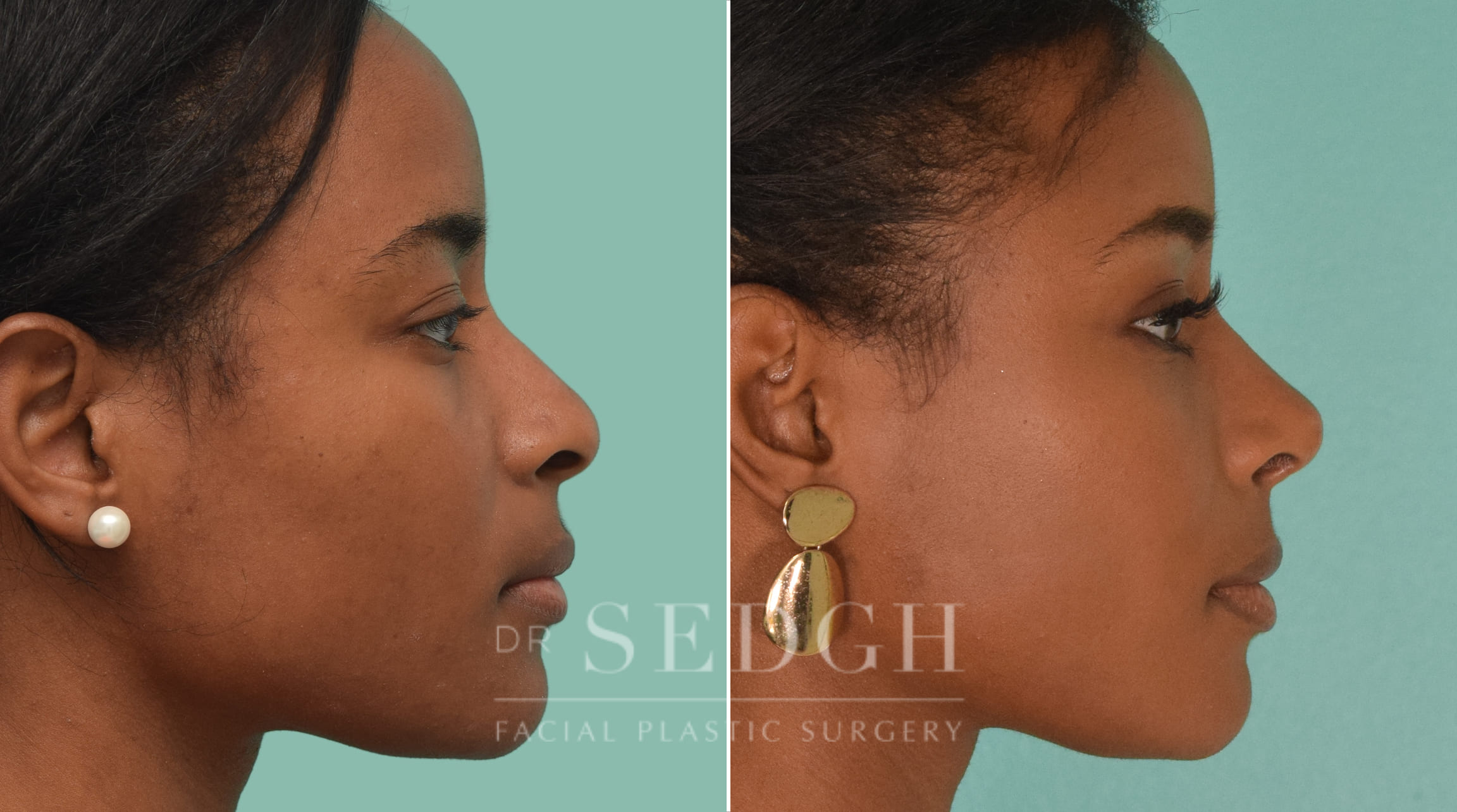 female patient before and after rhinoplasty procedure