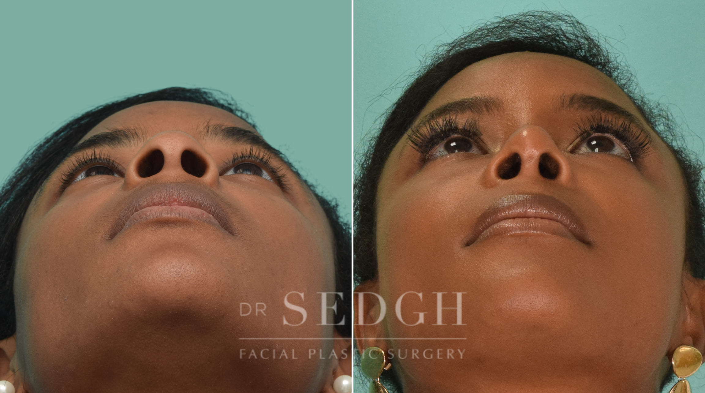 female patient before and after rhinoplasty procedure