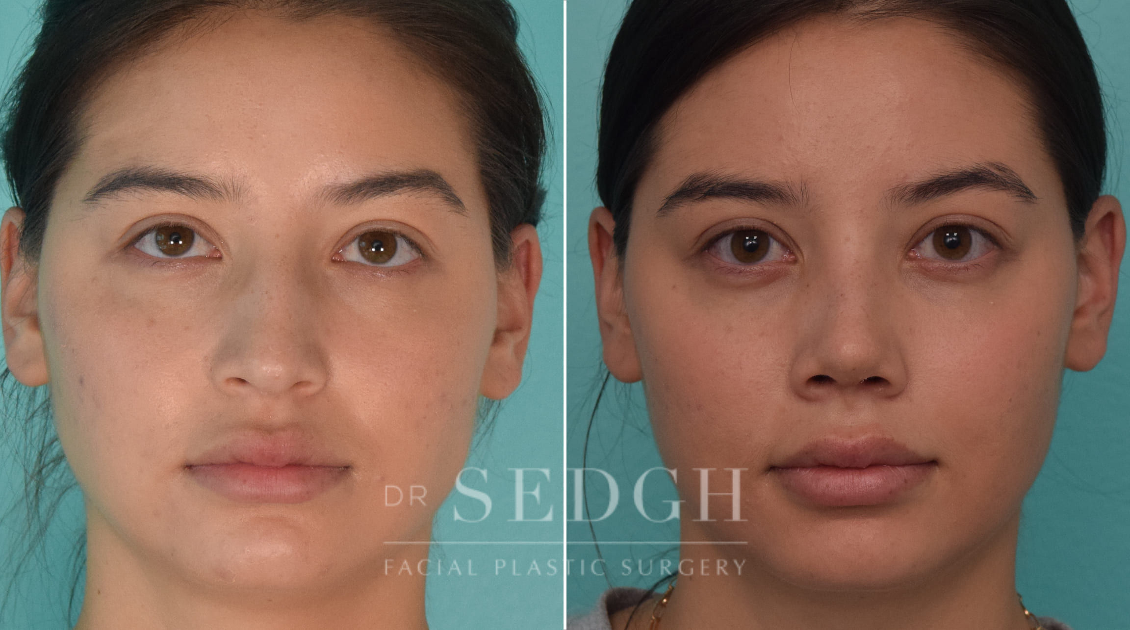 patient before and after rhinoplasty procedure