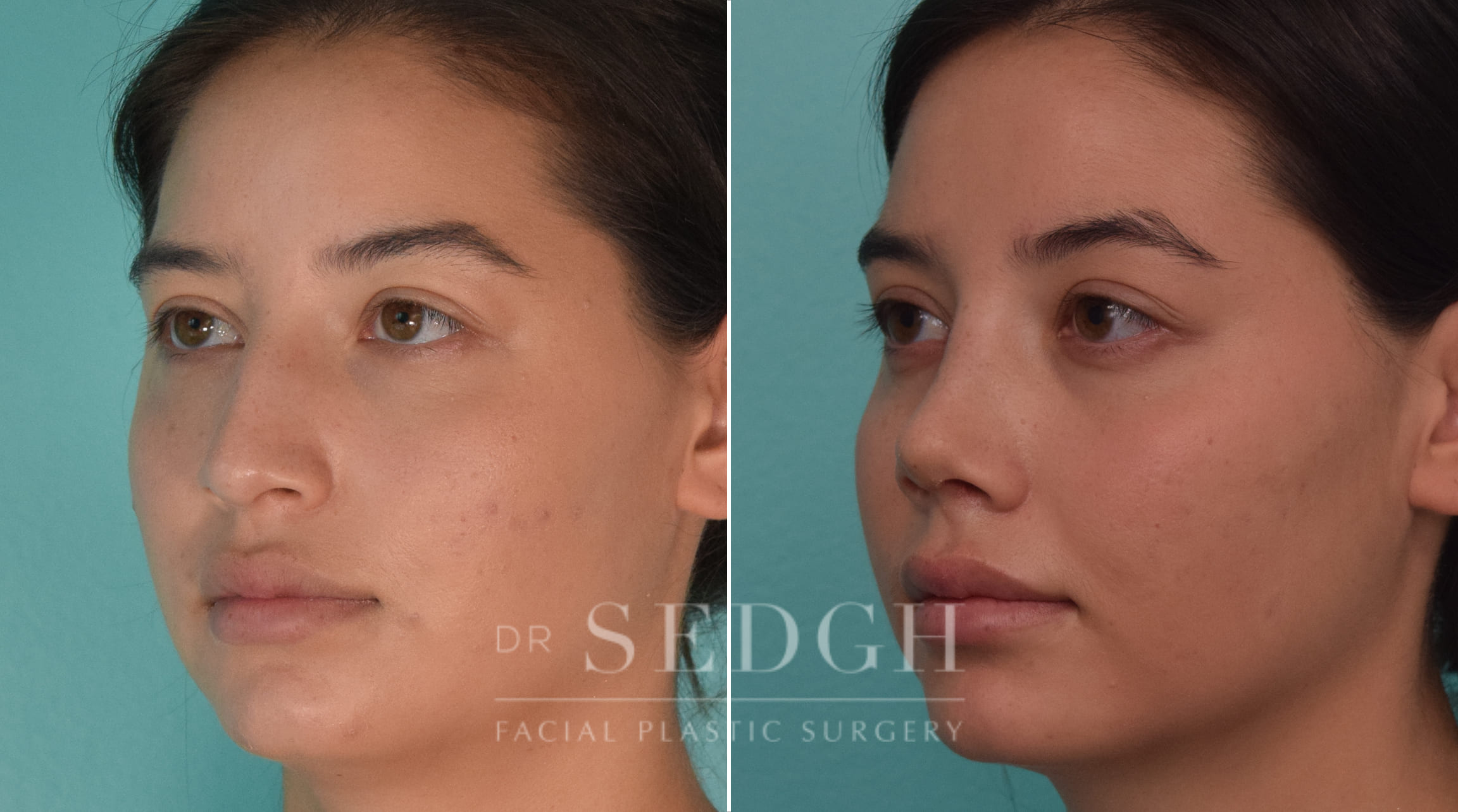 patient before and after rhinoplasty procedure