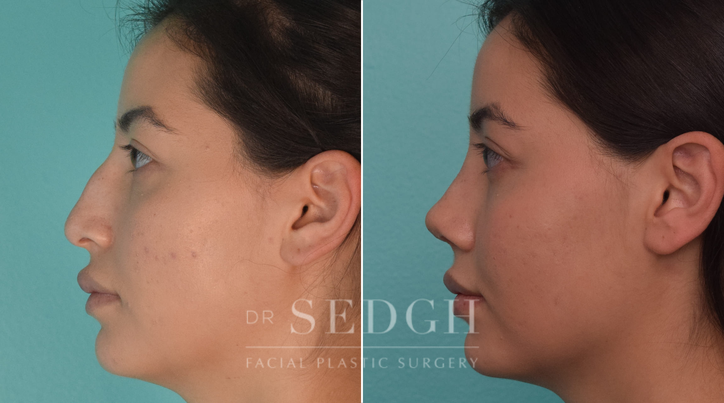 patient before and after rhinoplasty procedure